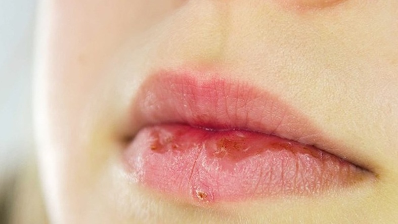 Bí quyết để không bị khô môi dịp cuối năm